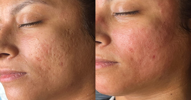 Microneedling Aftercare image